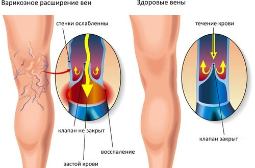 Лучший флеболог Одесса отзывы форум Тенистая Пастера поселок Котовского (сосудистая хирургия в Одессе)