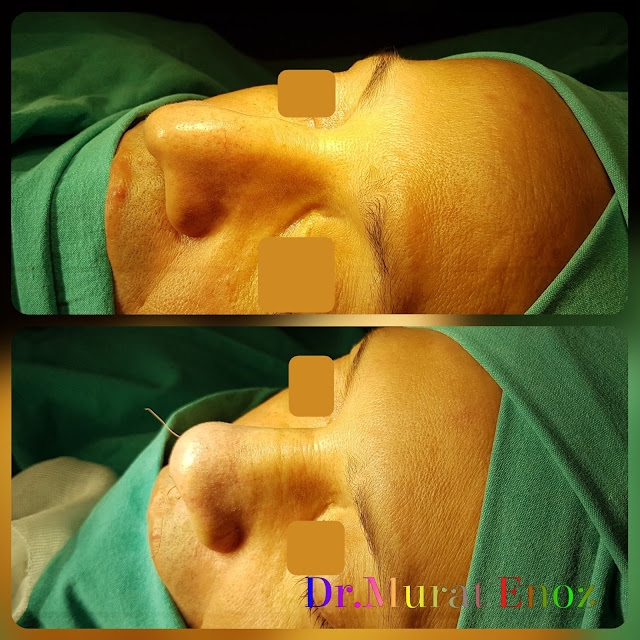 Droopy Nose Tip Aesthetic in Istanbul,Nose Tip Plasty in Istanbul, Ptotic Nasal Tip, Nose Tip Lifting,