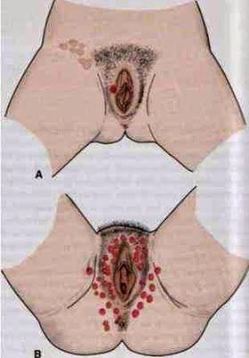 syphilis signs & symptoms