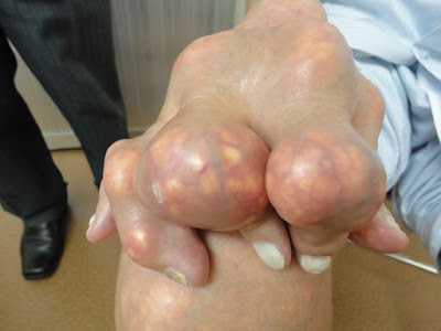 Biến chứng của bệnh gout