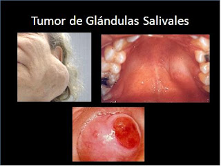 Resultado de imagen para tumor en glandulas salivales