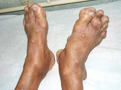 Triệu chứng bệnh gout