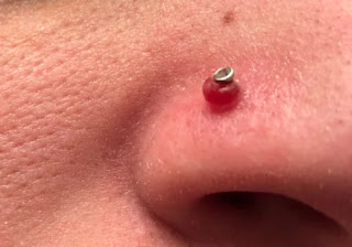 What Causes a Keloid on Nose Piercing