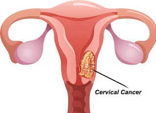 tanda kanser pangkal rahim rahim