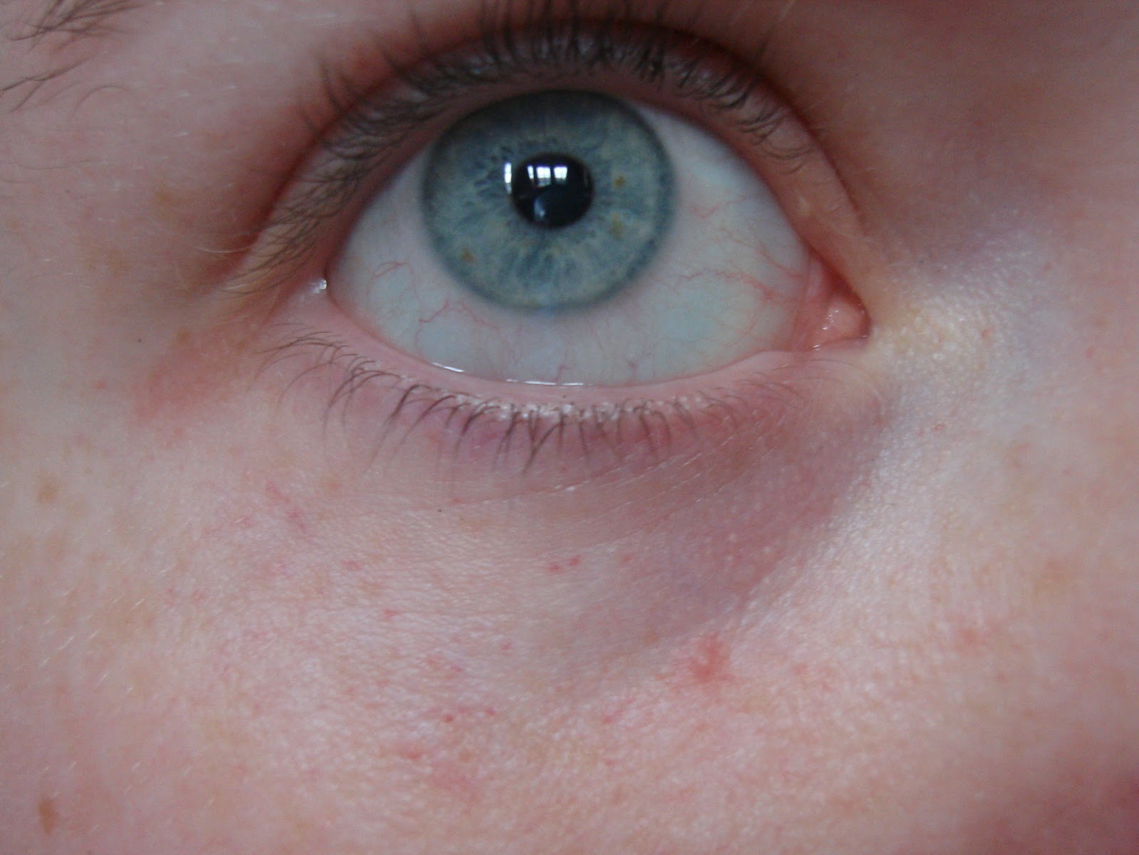 Broken Blood Vessels Under Eyes After Vomiting 