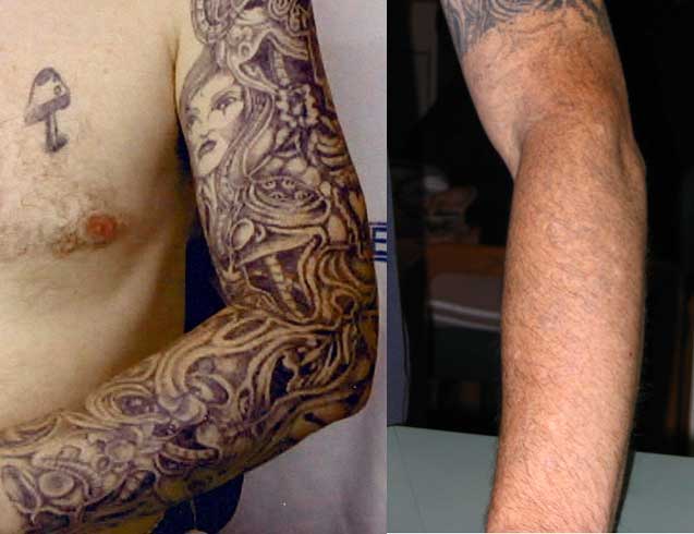Removal of a larger than 12inch arm tattoo using a Q-switched Nd/Yag ...