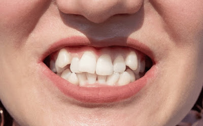 Straight Teeth