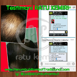 jual obat penumbuh rambut botak herbal ratu kemiri di banjarmasin 087823381610