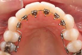 Metal Braces Cost