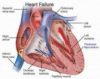 LAPORAN PENDAHULUAN CHF