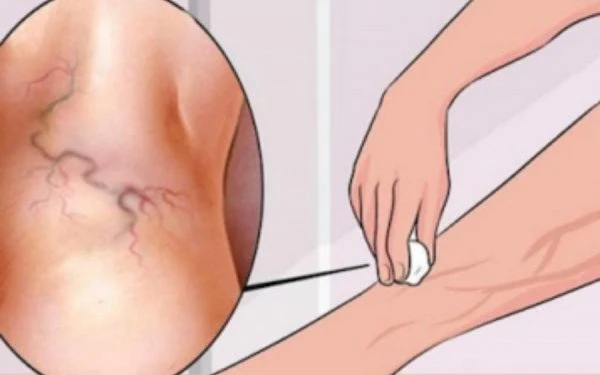 Eliminate Varicose Veins With This Granny Remedy