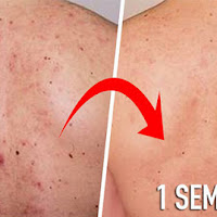 How To Remove Face And Back Acne By Using Incredible Natural Methods