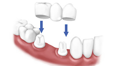 Trồng răng sứ đẹp bền theo công nghệ chuẩn quốc tế