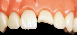 Răng bị gãy một nửa vẫn có thể phục hồi lại được