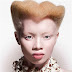 Can an Albino have sucess in life?