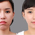 Niềng răng invisalign có tốt?