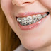 Răng hô nhẹ có những cách khắc phục nào?