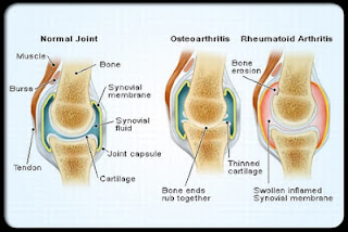  علاج الروماتيزم الروماتويد أو التهاب المفاصل الروماتيزمي