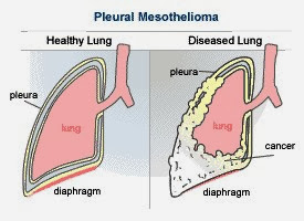A Guide To Understanding Pleural Mesothelioma
