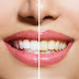 How To Whiten Teeth at Home in 3 Minutes With Simple Methode