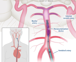 脳底動脈の血栓除去術の図