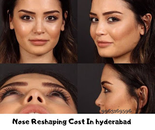 Nose surgery cost in hyderabad