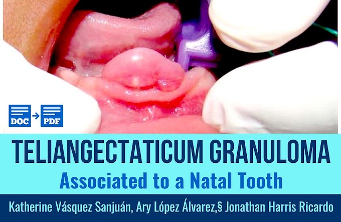 PDF: Teliangectaticum granuloma associated to a natal tooth