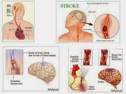 Pengobatan Herbal Penyakit Stroke Ringan, Gejala dan Penyebabnya