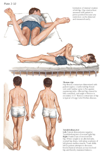 LEGG-CALVÉ-PERTHES DISEASE: PHYSICAL EXAMINATION