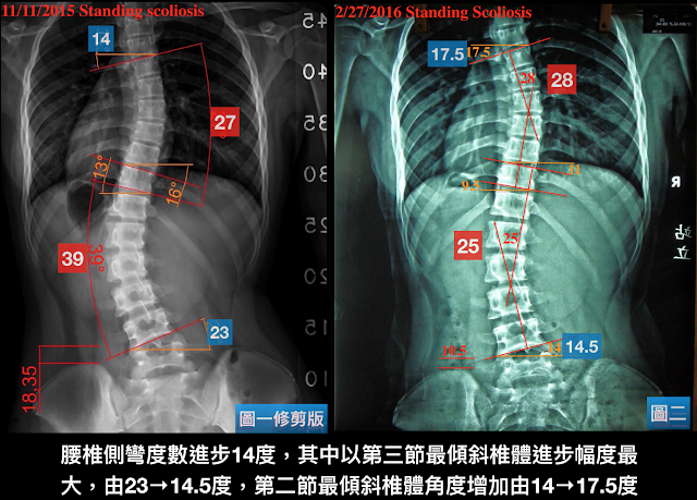 脊椎側彎, 脊椎側彎背架, 脊椎度數,脊椎側彎矯正, 脊椎側彎治療, 脊椎側彎矯正成功案例, 脊椎側彎 復健