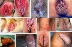 Genital warts