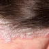 Cara mengobati gatal di kulit rambut kepala dengan obat alami
