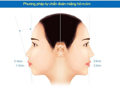  Phương pháp phẫu thuật hàm hô móm và 3D clear