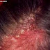 Photos Scalp Psoriasisscalp Eczemapictures Dandruff