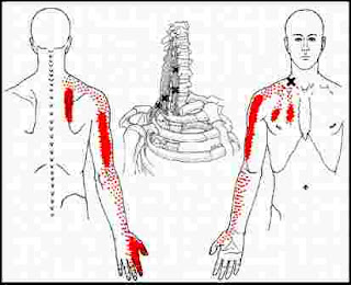 Other Raney Day Thoughts: Herniated Cervical Disc ...