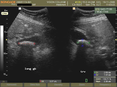 gallstones on ultrasound. Ultrasound showed a large