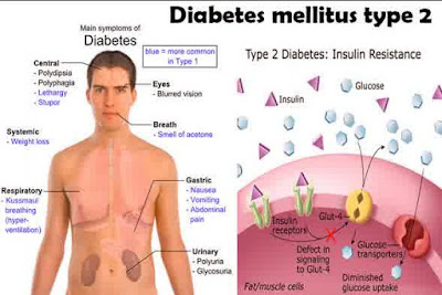 penyebab diabetes melitus tipe 2