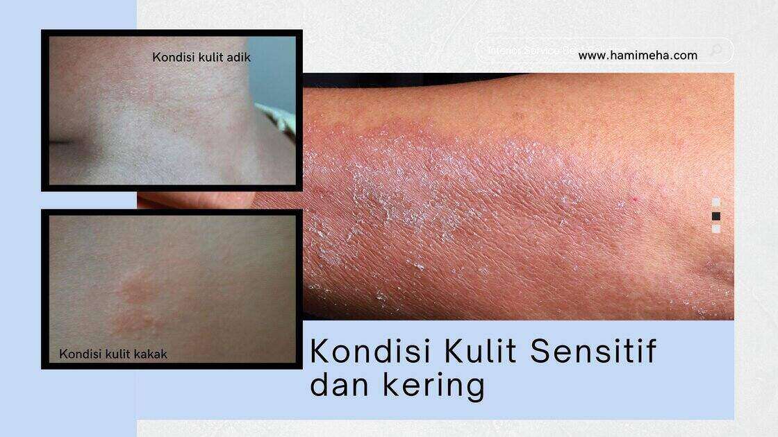 Apa itu kulit sensitif