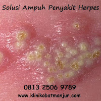 cara mengobati herpes kulit secara tradisional