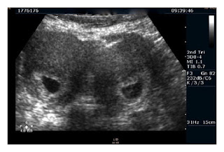   uterus bicornis, bicornuate unicollis uterus, bicornuate bicollis uterus, bicornuate uterus pregnancy, bicornuate uterus treatment, bicornuate uterus causes, bicornuate uterus symptoms, bicornuate uterus pregnancy pictures, partial bicornuate uterus