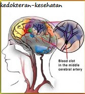 gejala stroke dan pencegahannya