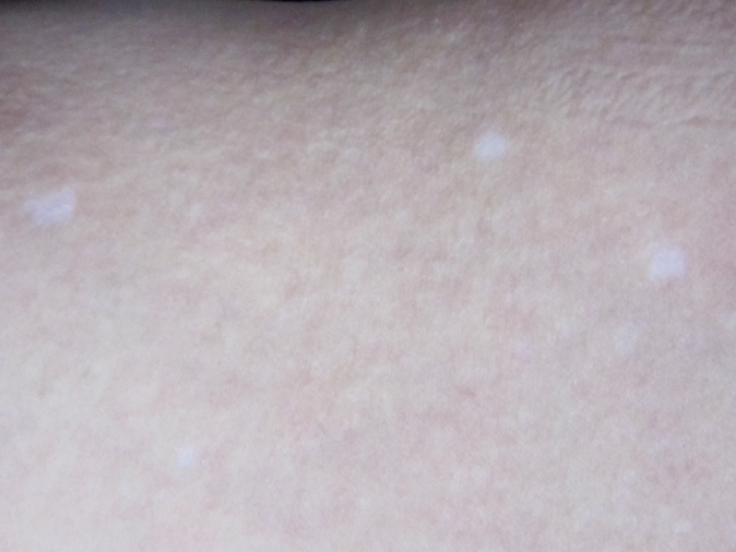 日に焼けたら老人性白斑が目立ってきた 雑談散歩