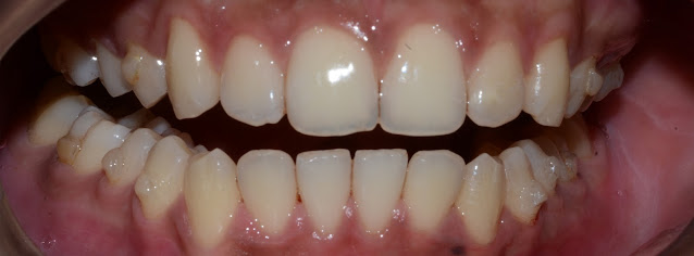 After Treatment of Space Between Front Teeth with Clear Aligner