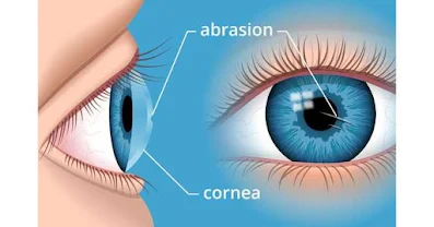 Kornea Nedir ? Kornea Nasıl Tedavi Edilir ?