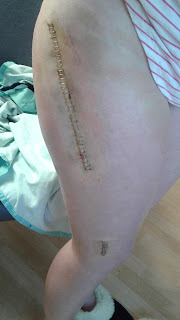 My right leg with a long line of staples. And another shorter one
