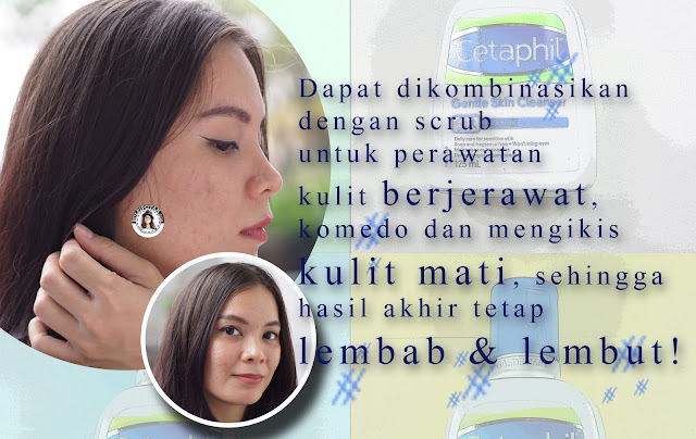 Testimoni+Produk+Cetaphil+di+kulit+berjerawat