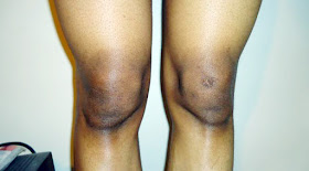 Cara Mencerahkan Lutut Hitam