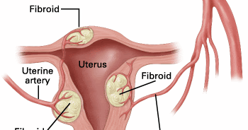 Rawatan Herba Dan Pemakanan: Merawat Fibroid Dengan Herba 