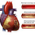 Penyakit jantung koroner dan pengobatannya
