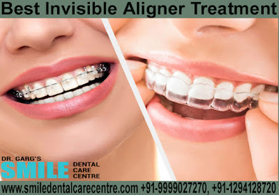 Best Invisible Aligner Treatment